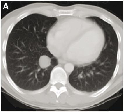 SBRT: metastasi polmonari SBRT in early stage NSCLC: