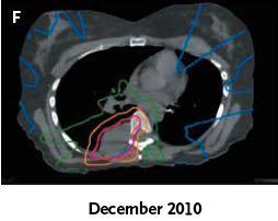 SBRT: immuno-modulazione SBRT: 2850