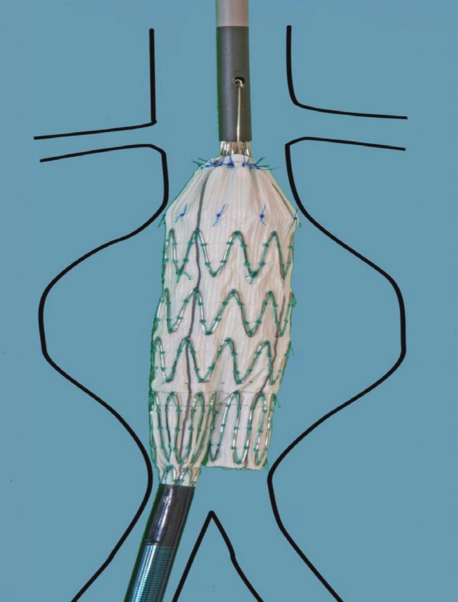 E. Civilini et al. FIGURA 2. Visualizzazione schematica di una fase dell impianto dell endoprotesi aortica.