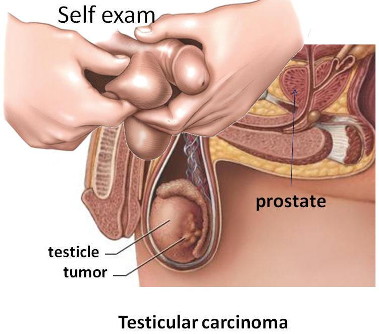 TUMORE DEL TESTICOLO importanza dell autopalpazione per una diagnosi precoce Andrebbe