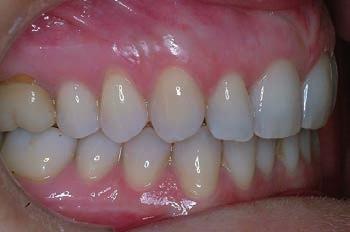 Inizialmente è stato chiuso il diastema tra 11-21 utilizzando un