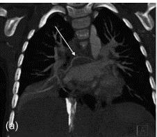 QUALITA DELL ARIA E SALUTE INFANTILE Incremento del rischio di : ROTTURA PREMATURA DELLE MEMBRANE: per CO, SO 2 e O 3 Wallace ME, Grantz KL, Exposure to Ambient Air Pollution and Premature Rupture of