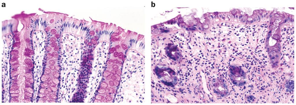 Figure 3 Human endoscopic biopsy samples of rectal mucosa obtained from a patient before and during ongoing radiation therapy of prostate cancer a PAS staining of healthy rectal mucosa before the