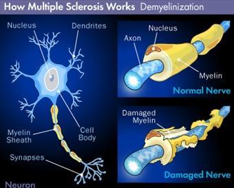 Fig3. Rappresentazione neurone sano e neurone con sclerosi multipla Anche se il meccanismo con cui la malattia si manifesta è stato ben compreso, l'esatta eziologia è ancora sconosciuta.
