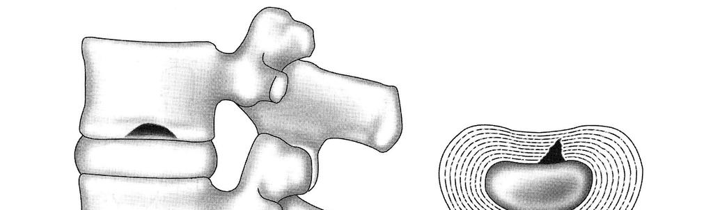 quanto le modificazioni degenerative possono estendersi (ed essere visibili) lungo tutta la colonna lombare, ma solo una di esse provoca sintomi dolorosi.