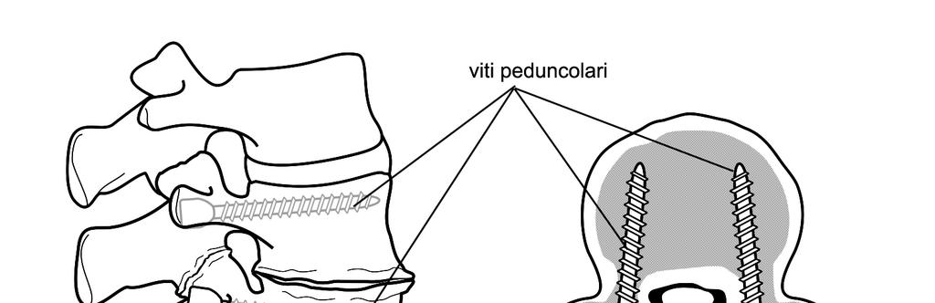 Successivamente si asporta il processo spinoso, la lamina destra e/o sinistra di una o più vertebre al fine di esporre il midollo spinale.