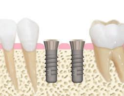 Se il paziente risulta idoneo, si procede alla pianificazione chirurgica scegliendo accuratamente l impianto ideale per qualità e quantità di osso, valutando accuratamente carico masticatorio e resa