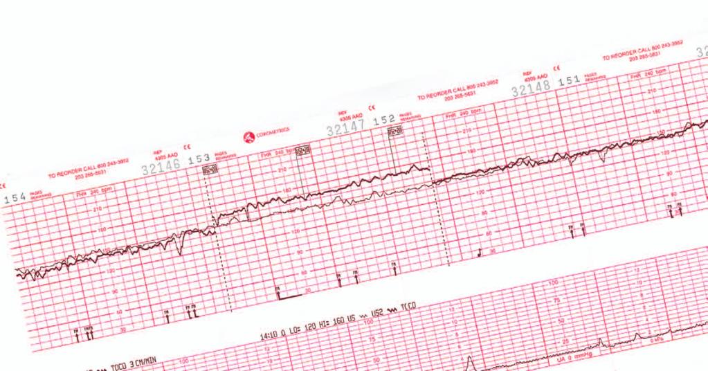 Caratteristiche Serie Corometrics 171 172 Trasduttore ad ultrasuoni impermeabile a 9 cristalli Nautilus Allarme frequenza cardiaca fetale Modalità offset frequenza cardiaca Coincidenza battito