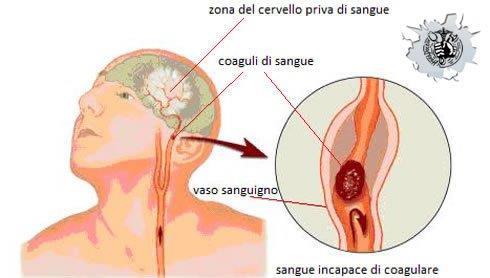 A distanza di poche ore ripete prelievo ed EGA che mostra Hb 8,9 g/dl Na 132 mmol/l Cl 95 mmol/l restanti parametri nella norma.