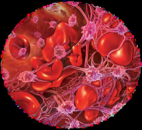 Seu: una malattia sistemica CNS Confusion Seizures Stroke Encephalopathy Diffuse cerebral dysfunction Pulmonary Pulmonary haemorrhage Pulmonary oedema Renal Proteinuria Malignant hypertension Renal