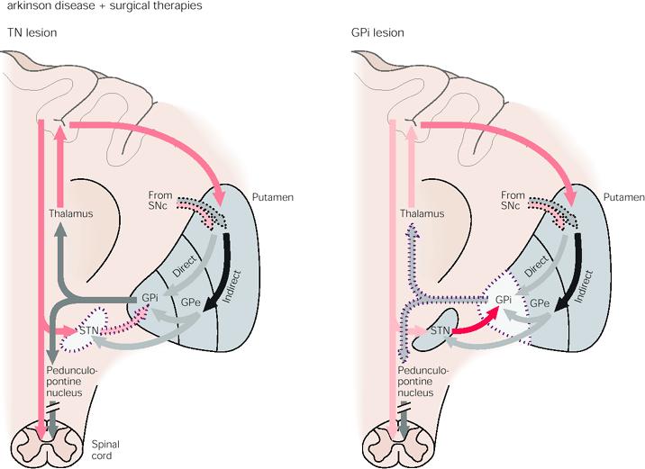 Parkinson: Neurochirurgia Lesione del nucleo subtalamico o del segmento interno del pallido Riducono la