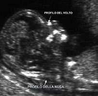 PERCORSO SCREENING PRENATALE SCREENING PRENATALE Gli esami cosiddetti di screening prenatale calcolano il rischio personale delle più comuni alterazioni cromosomiche (quali la trisomia 21 detta anche
