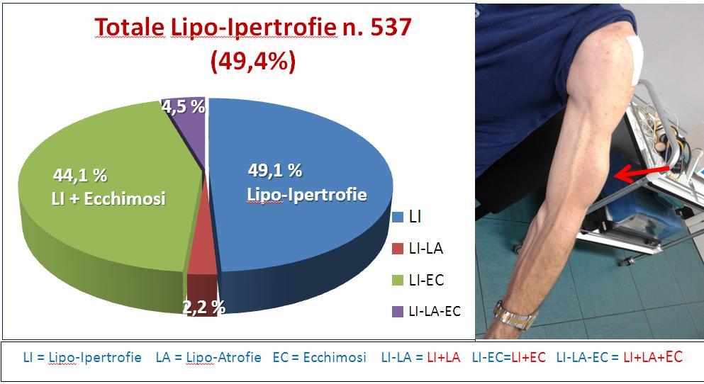 Le Lipo-Ipertrofie sono le lesioni