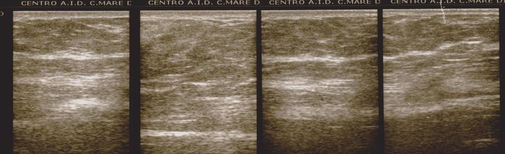 IMMAGINI ECOGRAFICHE DI NODULO LIPOIPERTROFICO IN ADDOME Noduli molli alla palpazione dopo 6 mesi di corretta rotazione risparmiate da punture Anni 68 BMI 35,6 kg/m 2 CASO N.