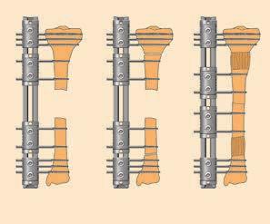 1 PARTE A: PRINCIPI GENERALI DIFETTO OSSEO DI ENTITÀ MEDIA: TRASPORTO OSSEO a) Difetto distale di entità media con accorciamento. Applicazione del sistema di ricostruzione degli arti con 3 morsetti.