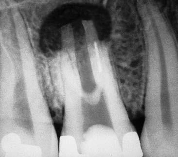 all insuccesso e alla frattura intracanalare dello strumento. È quindi opportuno, se si vuole evitare questo tipo di incidente, utilizzare una tecnica corretta di sagomatura.