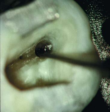 Micro Endodonzia: l eliminazione degli ostacoli intracanalari Figura 7 È possibile osservare il dislocamento in direzione coronale della lima fratturata (15x).