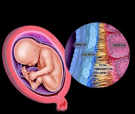 TEST BIOCHIMICI FIBRONECTINA FETALE (ffn) Glicoproteina prodotta dal corion con una