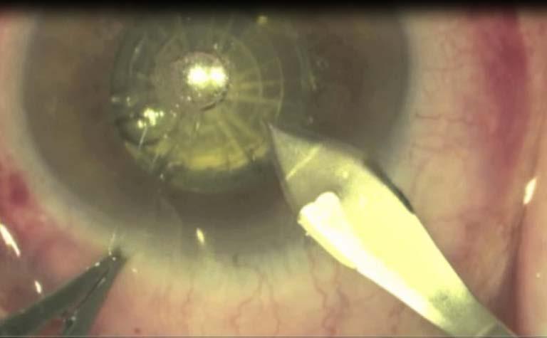 5 Incisioni corneali incomplete Le incisioni corneali effettuate con il laser a femtosecondi subito dopo la procedura laser sono complete ma necessitano dell apertura con uno strumento smusso nella
