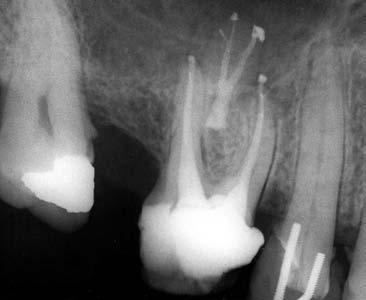 radicolari nelle tre dimensioni. La detersione e la sagomatura eseguita nelle tre dimensioni consente al dentista di raggiungere il suo obiettivo.