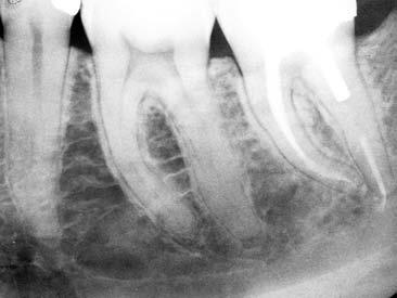 4 2000 Figura 4 Radiografia post-operatoria di un secondo molare inferiore sinistro con una radice mesiale lunga e piatta.