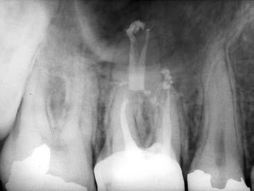 L angolo acuto del canale disto-palatino avrebbe potuto causare la frattura dello strumento, se una lima ruotante in nichel titanio si fosse introdotta accidentalmente in questo canale.