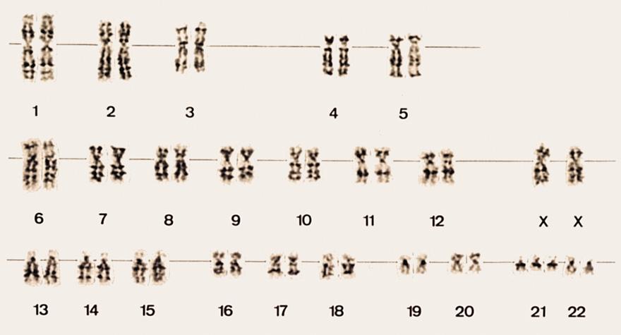 Meiosi e malattie genetiche La mancata disgiunzione di una coppia di omologhi o di due cromatidi può dare origine a