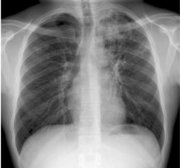4. Esame radiografico Le alterazioni osservate all esame radiografico del torace potrebbero essere suggestive, ma mai diagnostiche, per TB.