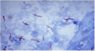 Due sono le tecniche più frequentemente impiegate a tal fine: microscopia in fluorescenza, previa colorazione con auramina-o oppure auramina-rodamina; (rapida e semplice) microscopia diretta, previa