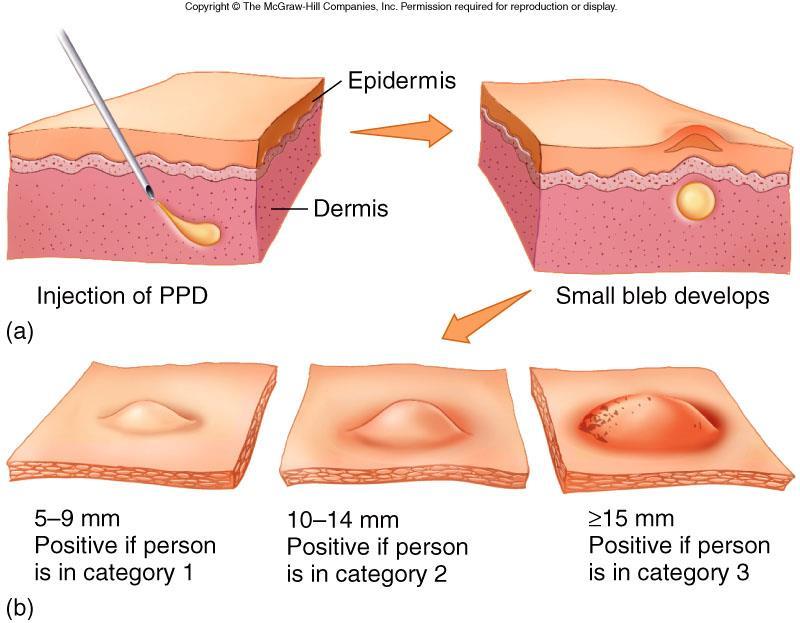 Test cutaneo per la tubercolosi: Mantoux test Si disinfetta una piccola superficie dell avambraccio, quindi si inietta superficialmente con una siringa da insulina con ago sottilissimo la dose di