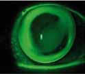 Non è tuttavia possibile ottenere un posizionamento perfettamente centrato per l eccessiva irregolarità della cornea ricevente, che si presenta molto stretta.
