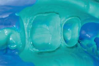 utilizzo di HYDRORISE su dentina, smalto, tessuti gengivali, ceramiche dentali, leghe e compositi.