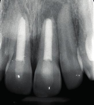 IV INCONTRO La disinfezione intracanalare Le medicazioni temporanee Il sigillo endodontico: materiali e tecniche Parte pratica: sagomatura del