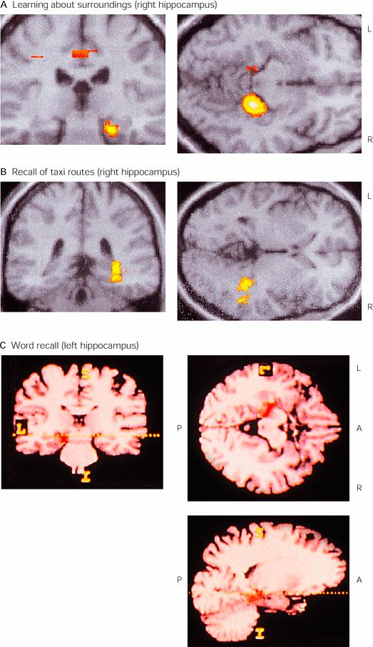 Ippocampo di sinistra e destra Attivazioni cerebrali nell ippocampo di destra durante la scansione visiva ed apprendimento di relazioni spaziali