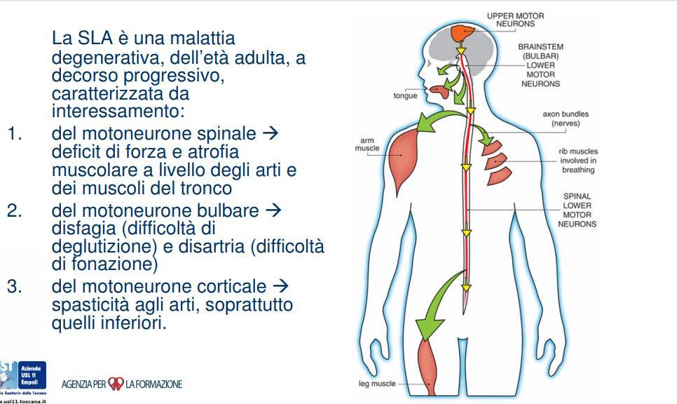 LA SLA È CARATTERIZZATA DA UN