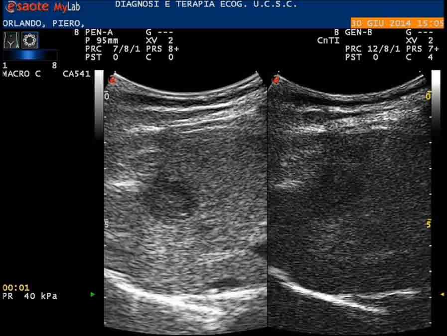 Iter diagnos:co Ad una RMN addome riscontro occasionale di formazione epa:ca del diametro di 18mm, non evidente l anno prima con restante parenchima normale e lieve aumento di α- Fetoproteina: 14