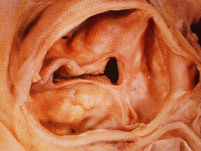 Valvola Aortica CHIRURGIA RICOSTRUTTIVA Punti di sutura : prolene, ethibond, goretex