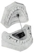 Dai dati forniti risulterà sia una molatura 105/0 111 123 105/1 105/2 105/3 105/4 selettiva di correzione, sia il rimontaggio dei denti, etc.