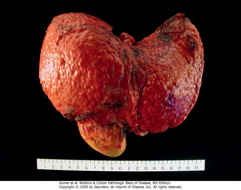 Cirrosi epatica Risultato finale: fegato fibrotico, nodulare,