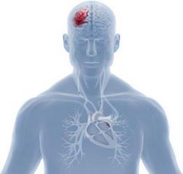 Fibrillazione atriale FA (5% oltre i 65 anni) è la causa più comune di ictus ischemico nella popolazione anziana (2-7 volte più frequente) Gli ictus dovuti a FA sono più gravi e disabilitanti