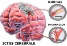 L ictus è un problema sociale Prima causa di disabilità Terza causa di morte Seconda causa di