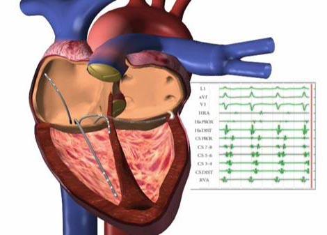 PUNTURA TRANSETTALE Qualora fosse necessario mappare le camere sinistre del cuore (ventricolo o atrio sinistro) può essere necessario, in assenza di una comunicazione tra atri già presente (forame