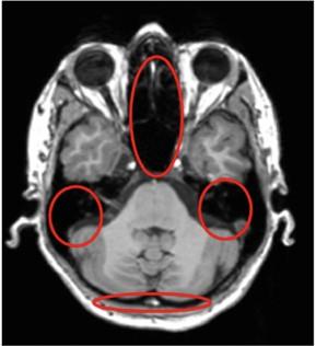 Correzione attenuazione e MRI 1) Il campo di vista MRI e molto piu piccolo di quello TAC e PET (zona di uniformita del campo magnetico). Troncamento degli arti.