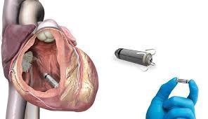 si inserisce in prossimità del cuore in una tasca sottocutanea supplisce alla funzione del