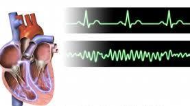 Frequenza cardiaca 60 90 bpm Frequenza cardiaca media 72 bpm >100 bpm Tachicardia <60 bpm Bradicardia 450 bpm fibrillazione ventricolare Le aritmie possono compromettere la capacità del cuore di