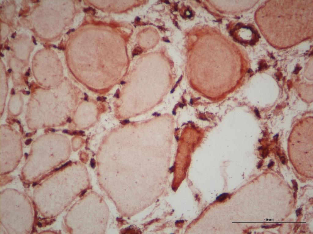 BIOPSIA MUSCOLARE: OM Alcune fibre per lo più ipo/atrofiche raggruppate riesprimono la vimentina Numerose fibre atrofiche e alcune fibre normotrofiche sparse o in piccolo gruppo riesprimono l N-CAM