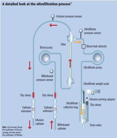 L ULTRAFILTRAZIONE Tecnica dialitica esclusivamente depletiva, che sfrutta un gradiente di pressione idrostatica L acqua plasmatica