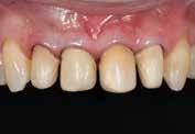 G-Premio BOND contiene tre monomeri funzionali per garantire l a ogni preparazione, indipendentemente dal fatto che si tratti di dentina, smalto, metallo o composito.