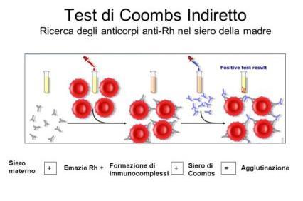 Test di Coombs Il test di Coombs, è un test di laboratorio utilizzato per rilevare la presenza di anticorpi fissati alla superficie dei globuli rossi (test di Coombs diretto), oppure