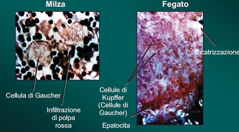 Cellule di Gaucher